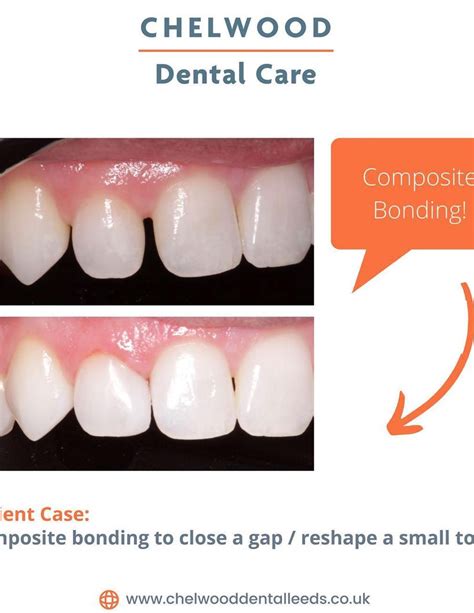 composite teeth veneers|Composite Bonding vs Veneers .